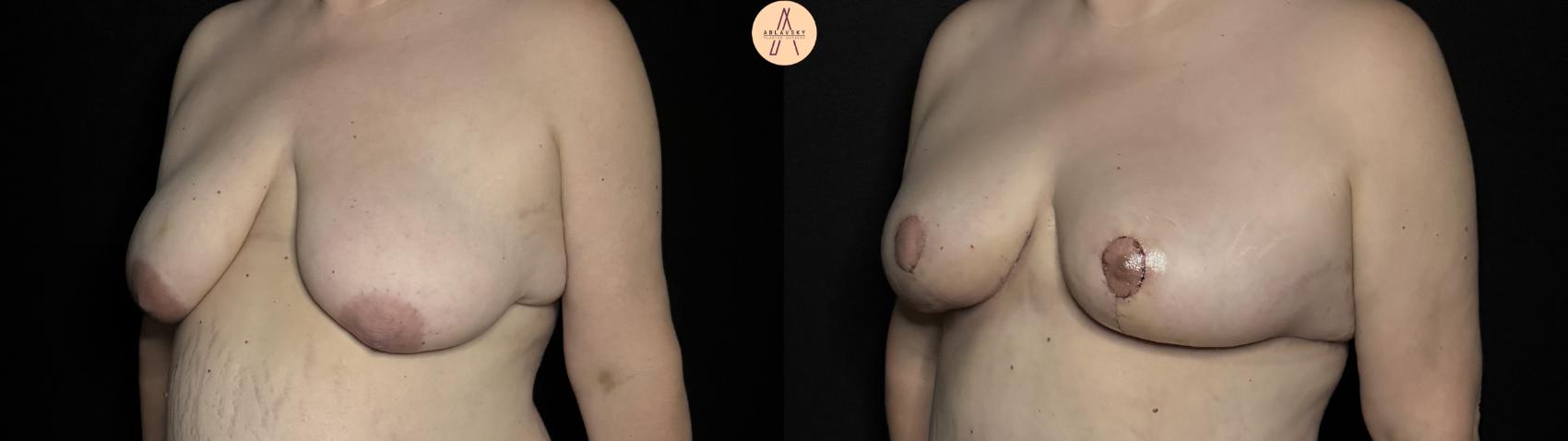 Before & After Breast Lift with Fat Grafting Case 340 Left Oblique View in San Antonio, Texas