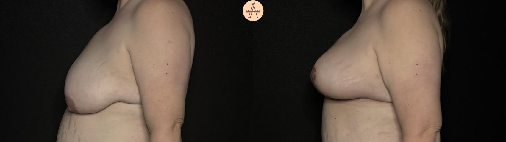 Before & After Breast Lift with Fat Grafting Case 340 Left Side View in San Antonio, Texas