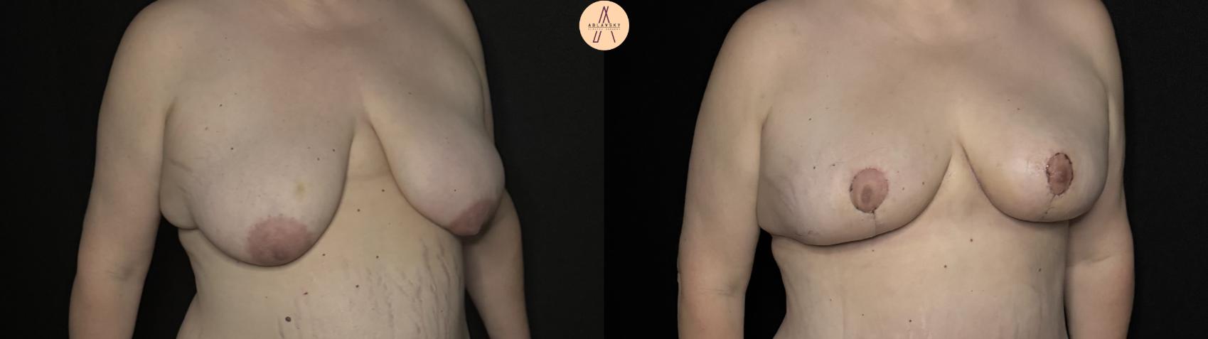 Before & After Breast Lift with Fat Grafting Case 340 Right Oblique View in San Antonio, Texas