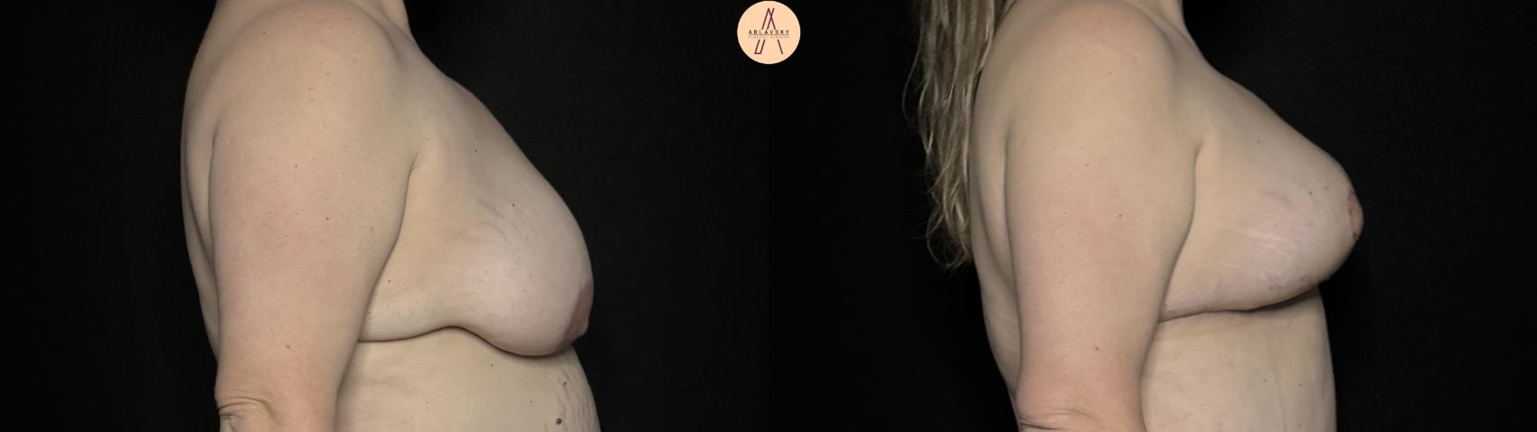 Before & After Breast Lift with Fat Grafting Case 340 Right Side View in San Antonio, Texas