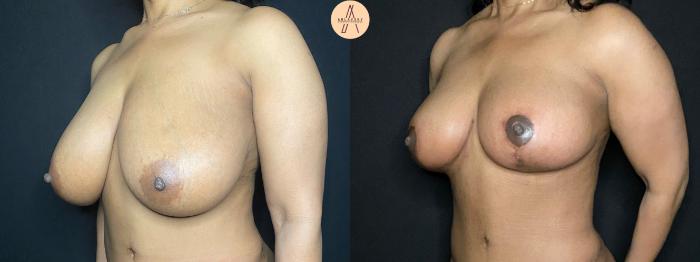 Before & After Breast Reduction Case 105 Left Oblique View in San Antonio, Texas