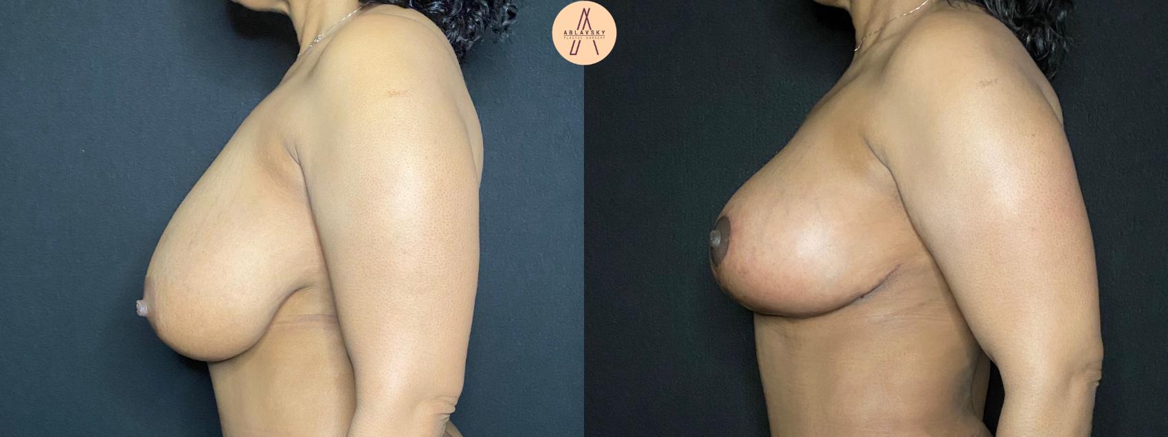 Before & After Breast Reduction Case 105 Left Side View in San Antonio, Texas