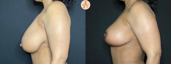 Before & After Breast Reduction Case 105 Left Side View in San Antonio, Texas
