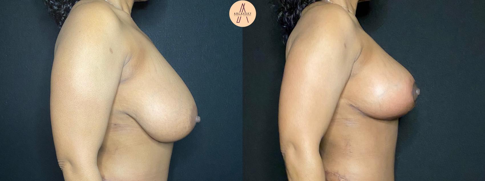 Before & After Breast Reduction Case 105 Right Side View in San Antonio, Texas
