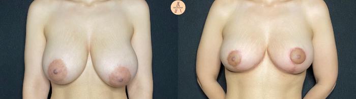 Before & After Breast Lift Case 131 Front View in San Antonio, Texas