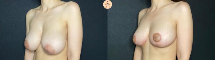 Before & After Breast Lift Case 131 Left Oblique View in San Antonio, Texas