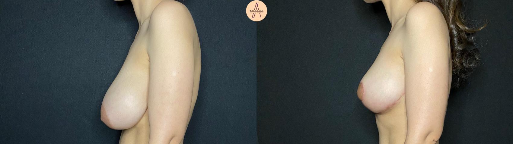 Before & After Breast Reduction Case 131 Left Side View in San Antonio, Texas