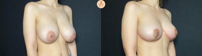 Before & After Breast Reduction Case 131 Right Oblique View in San Antonio, Texas