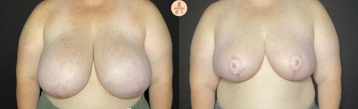 Before & After Breast Reduction Case 148 Front View in San Antonio, Texas