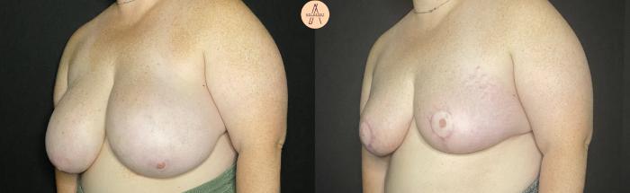 Before & After Breast Reduction Case 148 Left Oblique View in San Antonio, Texas