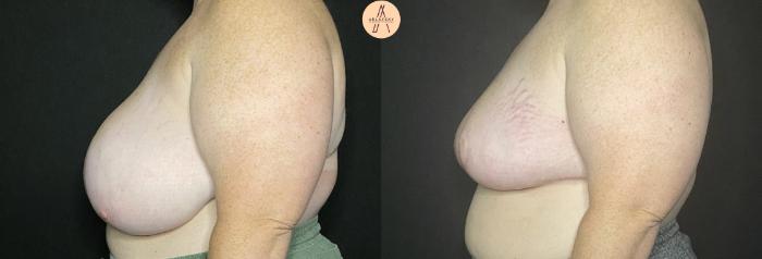 Before & After Breast Reduction Case 148 Left Side View in San Antonio, Texas