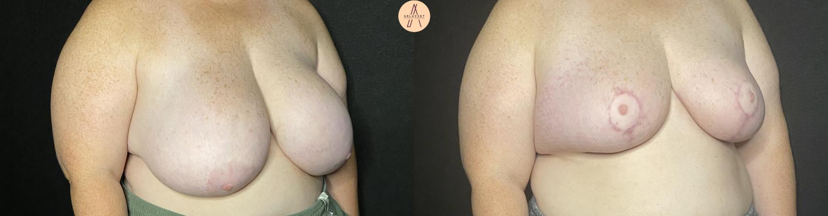 Before & After Breast Reduction Case 148 Right Oblique View in San Antonio, Texas