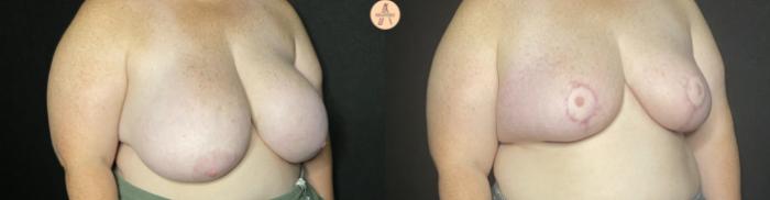 Before & After Breast Reduction Case 148 Right Oblique View in San Antonio, Texas