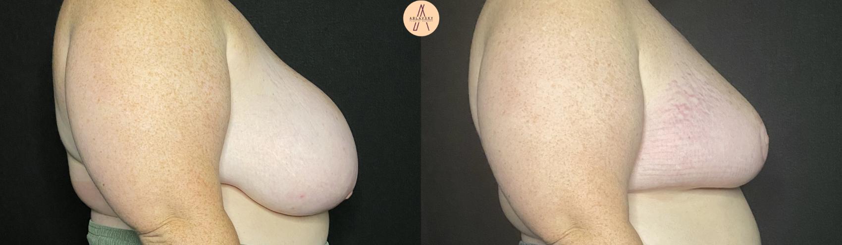 Before & After Breast Reduction Case 148 Right Side View in San Antonio, Texas