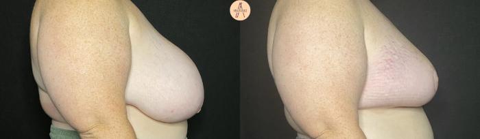 Before & After Breast Reduction Case 148 Right Side View in San Antonio, Texas