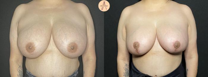 Before & After Breast Reduction Case 168 Front View in San Antonio, Texas