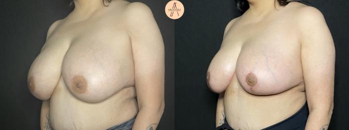 Before & After Breast Lift Case 168 Left Oblique View in San Antonio, Texas