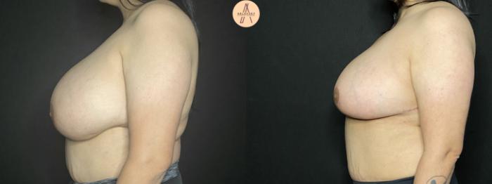 Before & After Breast Reduction Case 168 Left Side View in San Antonio, Texas
