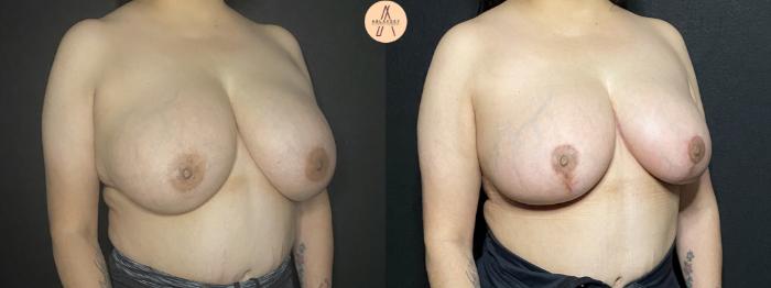 Before & After Breast Reduction Case 168 Right Oblique View in San Antonio, Texas