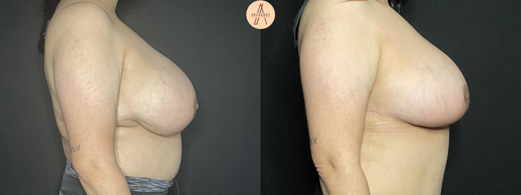 Before & After Breast Lift Case 168 Right Side View in San Antonio, Texas