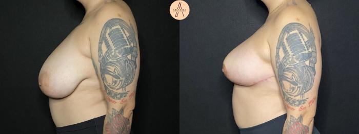 Before & After Breast Reduction Case 171 Left Side View in San Antonio, Texas