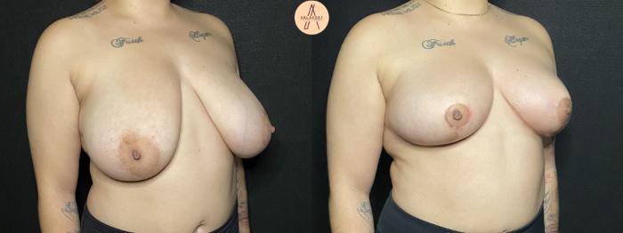 Before & After Breast Reduction Case 171 Right Oblique View in San Antonio, Texas