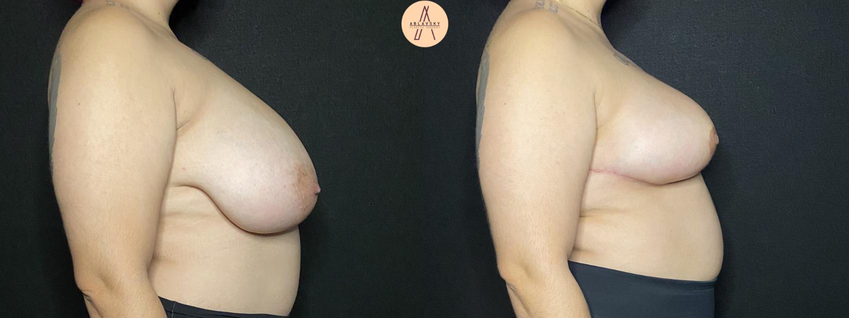Before & After Breast Reduction Case 171 Right Side View in San Antonio, Texas