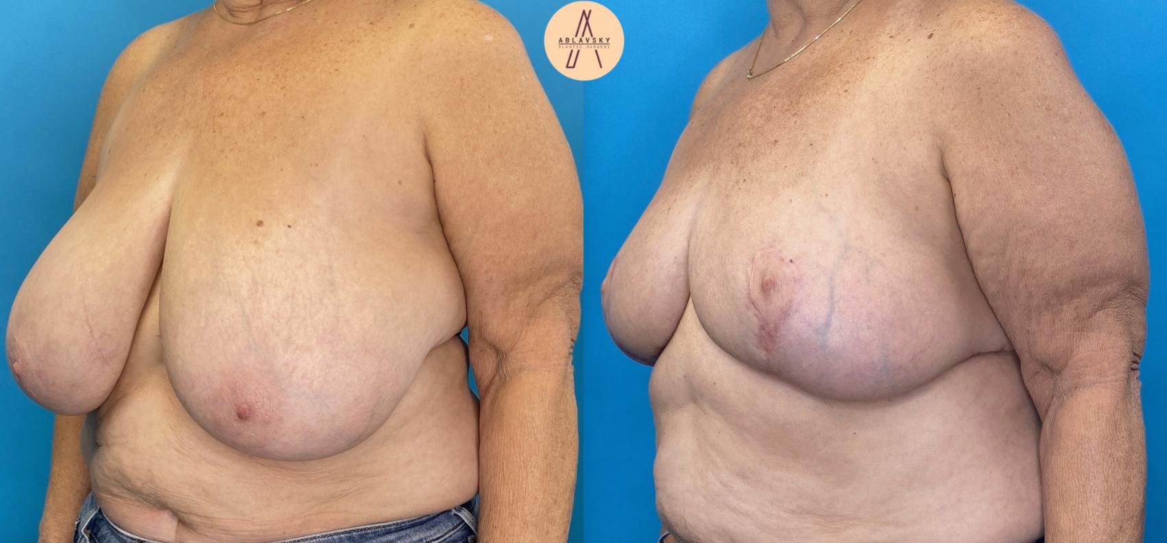 Before & After Breast Reduction Case 18 Left Oblique View in San Antonio, Texas
