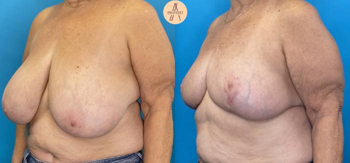 Before & After Breast Reduction Case 18 Left Oblique View in San Antonio, Texas