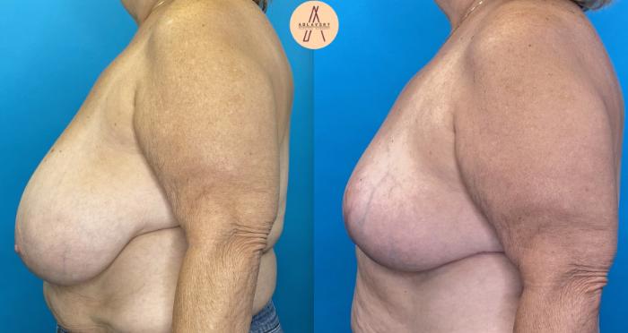 Before & After Breast Reduction Case 18 Left Side View in San Antonio, Texas