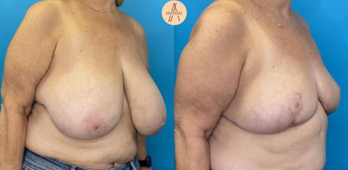 Before & After Breast Reduction Case 18 Right Oblique View in San Antonio, Texas