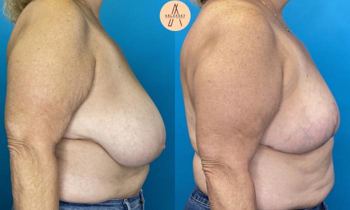 Before & After Breast Reduction Case 18 Right Side View in San Antonio, Texas