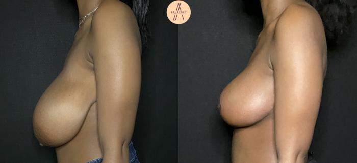 Before & After Breast Lift Case 180 Left Side View in San Antonio, Texas