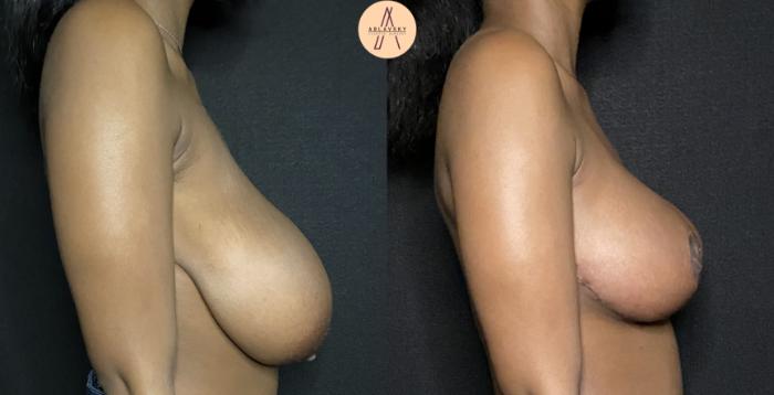 Before & After Breast Reduction Case 180 Right Side View in San Antonio, Texas