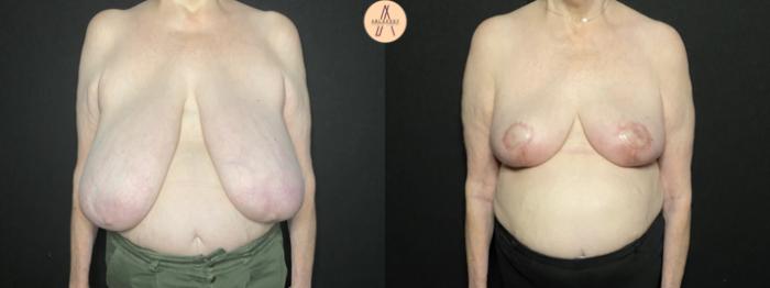 Before & After Breast Reduction Case 183 Front View in San Antonio, Texas