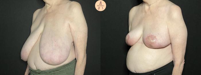 Before & After Breast Reduction Case 183 Left Oblique View in San Antonio, Texas