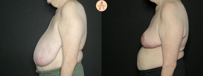 Before & After Breast Reduction Case 183 Left Side View in San Antonio, Texas