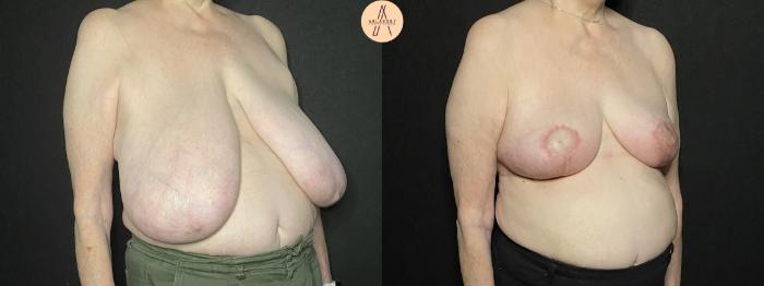 Before & After Breast Reduction Case 183 Right Oblique View in San Antonio, Texas
