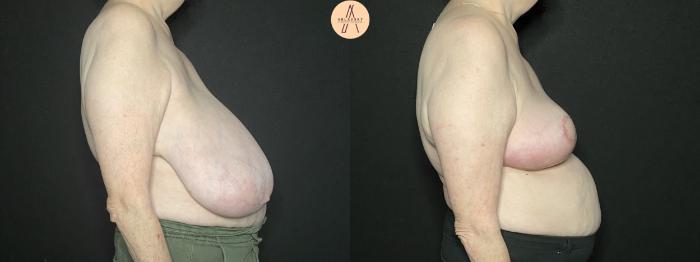 Before & After Breast Reduction Case 183 Right Side View in San Antonio, Texas