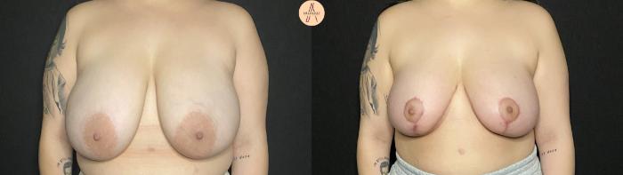 Before & After Breast Reduction Case 187 Front View in San Antonio, Texas