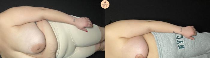 Before & After Breast Reduction Case 187 Left Oblique View in San Antonio, Texas