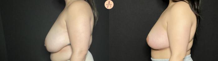 Before & After Breast Reduction Case 187 Left Side View in San Antonio, Texas