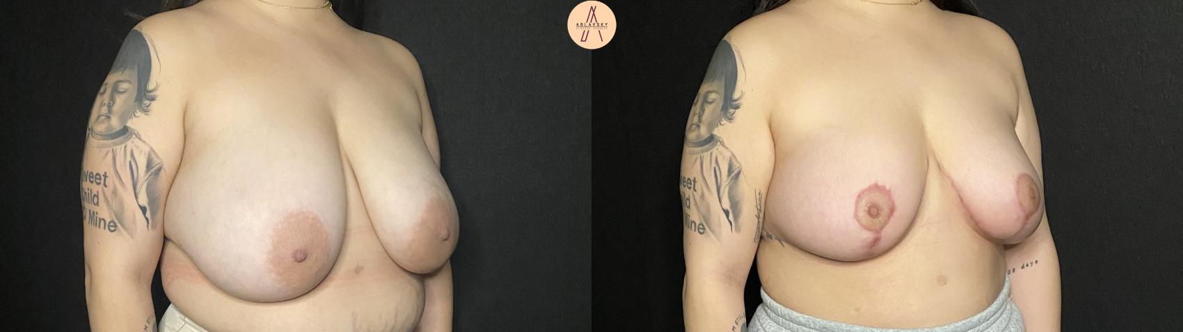 Before & After Breast Reduction Case 187 Right Oblique View in San Antonio, Texas