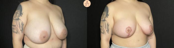 Before & After Breast Lift Case 187 Right Oblique View in San Antonio, Texas