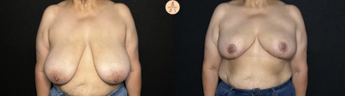 Before & After Breast Reduction Case 244 Front View in San Antonio, Texas