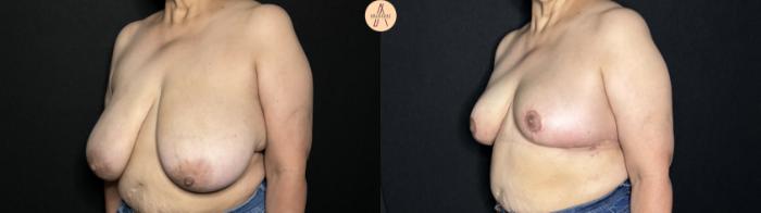 Before & After Breast Reduction Case 244 Left Oblique View in San Antonio, Texas