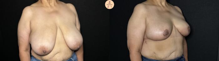 Before & After Breast Reduction Case 244 Right Oblique View in San Antonio, Texas