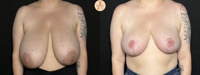 Before & After Breast Reduction Case 260 Front View in San Antonio, Texas