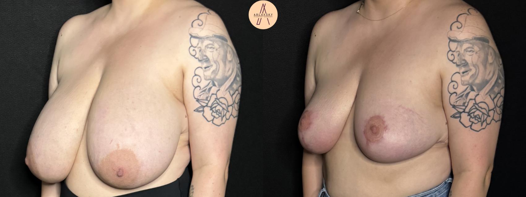Before & After Breast Reduction Case 260 Left Oblique View in San Antonio, Texas