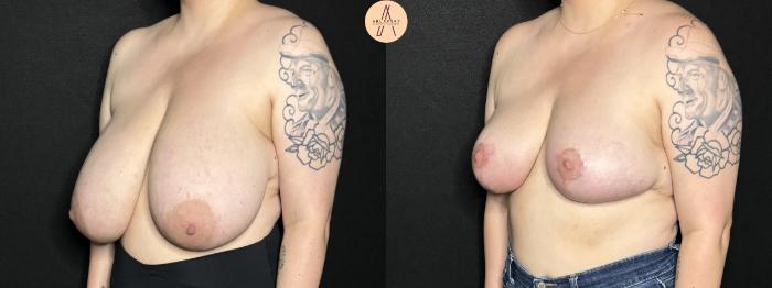 Before & After Breast Reduction Case 260 Left Oblique View in San Antonio, Texas